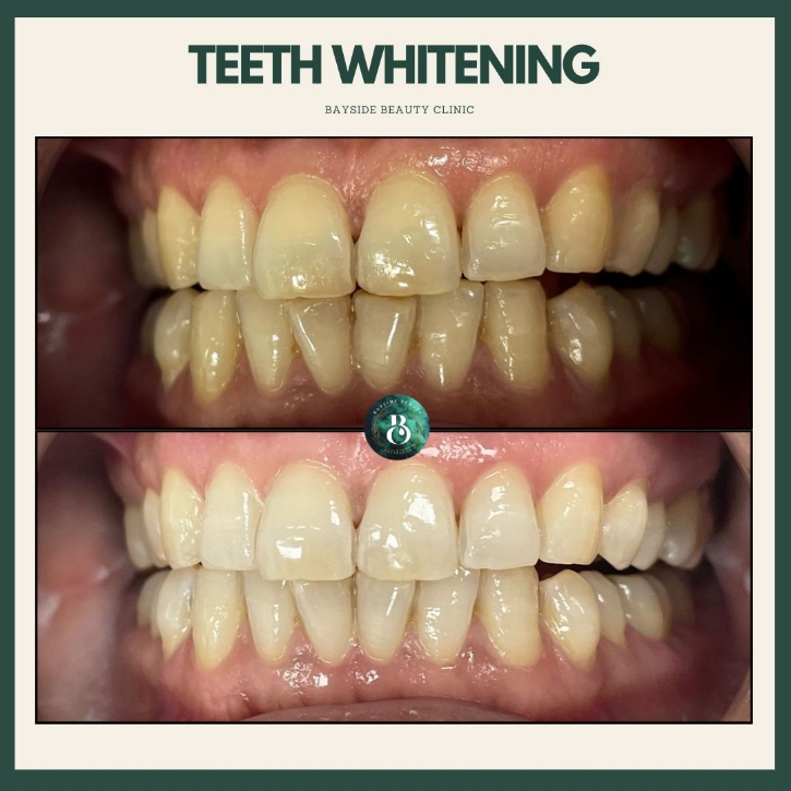 Aesthetics Treatments Walsall - Teeth Whitening