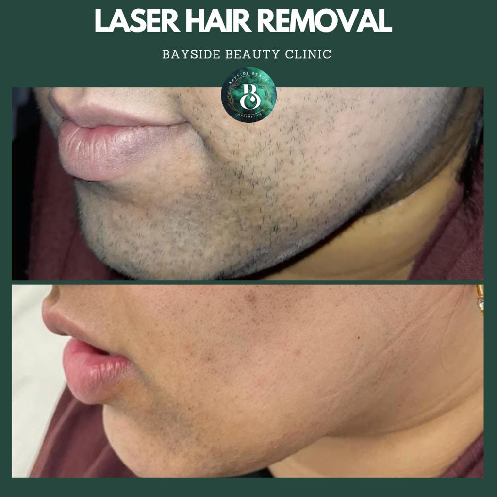 Laser hair removal Walsall