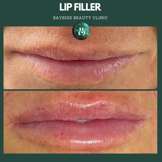 Lip Fillers treatment at Bayside Walsall